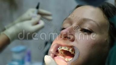 安装金属牙套特写，拜访牙医.. 牙齿矫正师在牙齿上盖上印章和贴片